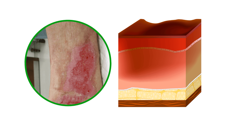 second degree burn on leg and skin layers